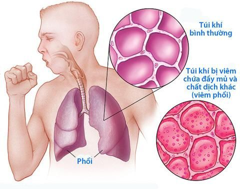 Viêm phổi là bệnh về đường hô hấp rất phổ biến