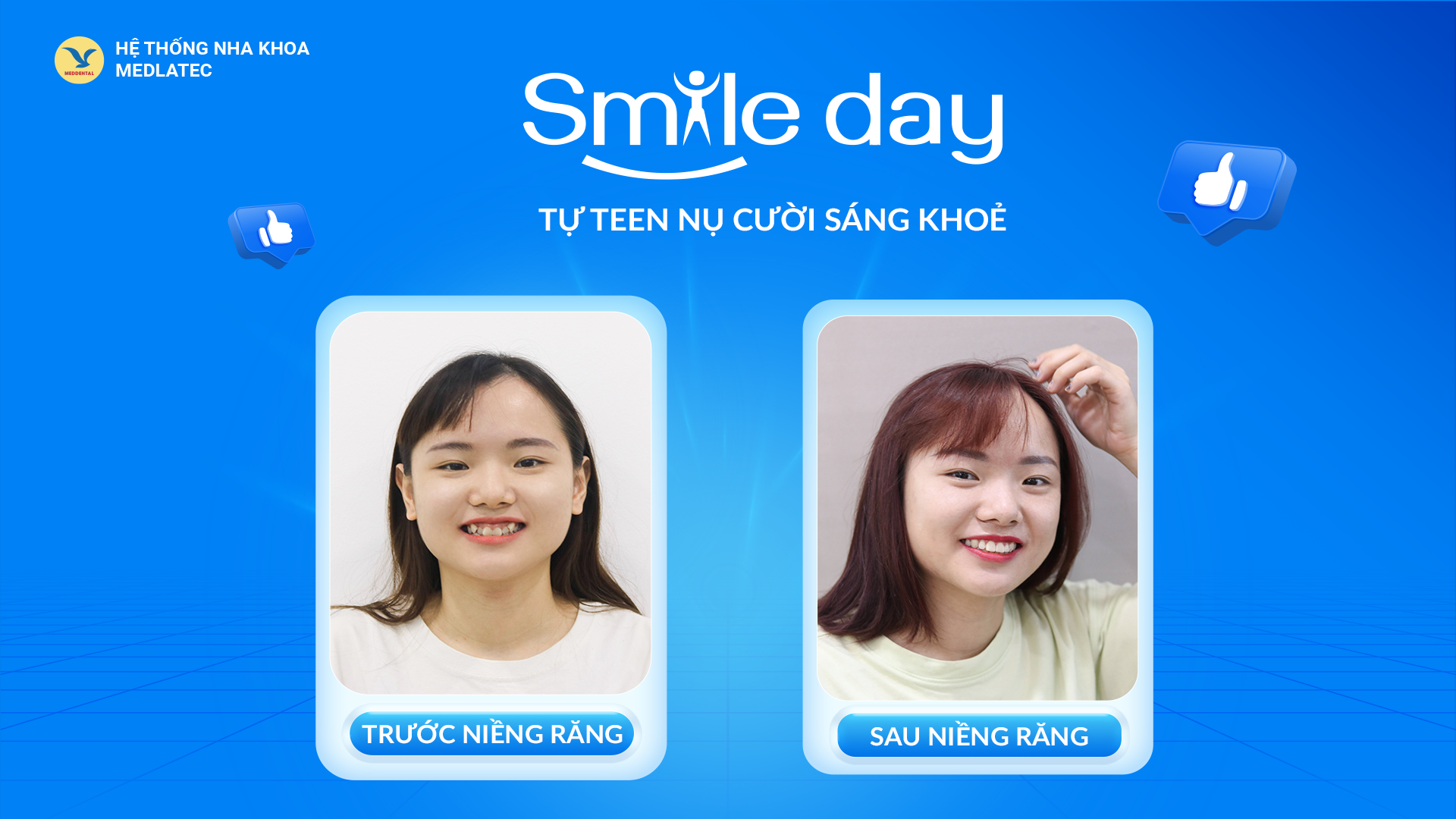 Nhổ răng kết hợp với khí cụ chỉnh nha giúp cải thiện tình trạng răng