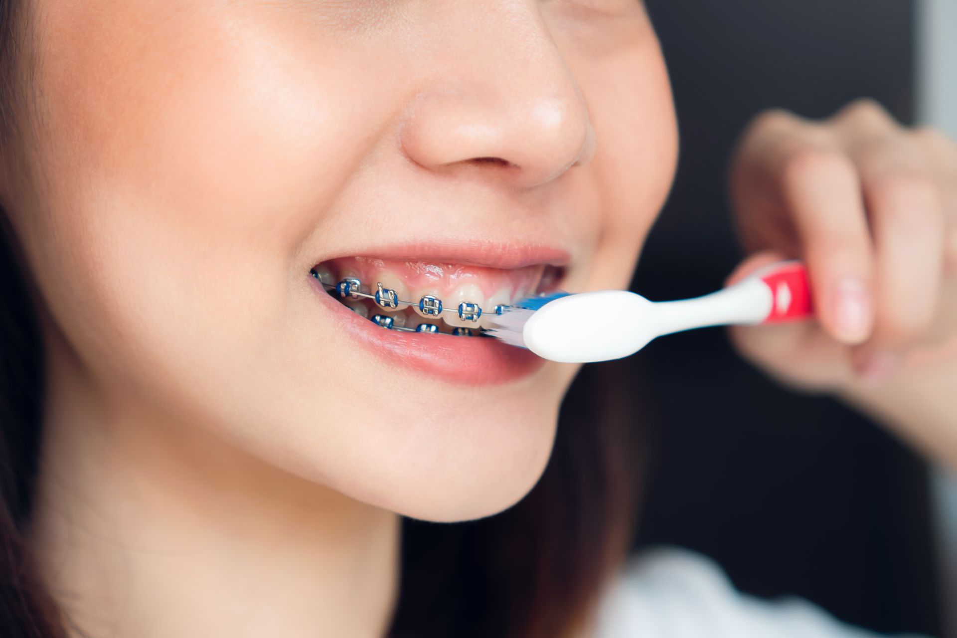 Chải răng đúng cách với bàn chải mềm và chỉ nha khoa giúp người niềng răng vệ sinh hiệu quả Chải răng đúng cách với bàn chải mềm và chỉ nha khoa giúp người niềng răng vệ sinh hiệu quả