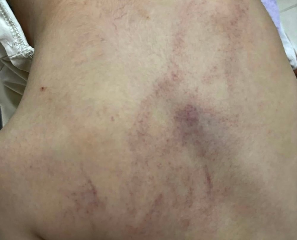Trên lưng bé mầm non xuất hiện nhiều vết bầm tím Trên lưng bé mầm non xuất hiện nhiều vết bầm tím