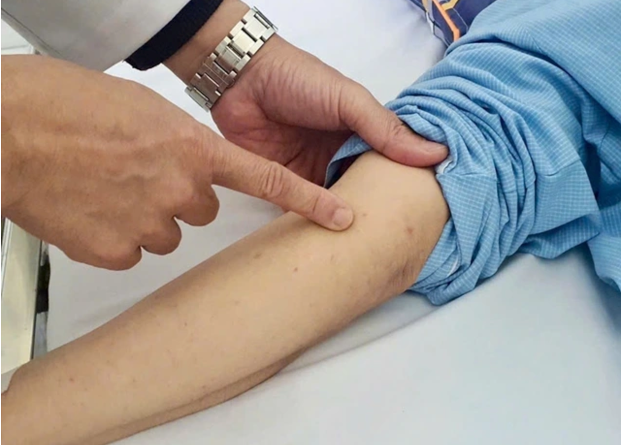 B&ecirc;̣nh vi&ecirc;m não m&ocirc; c&acirc;̀u có tỷ l&ecirc;̣ tử vong cao và đ&ecirc;̉ lại những di chứng l&acirc;u dài đ&ocirc;́i với trẻ em.