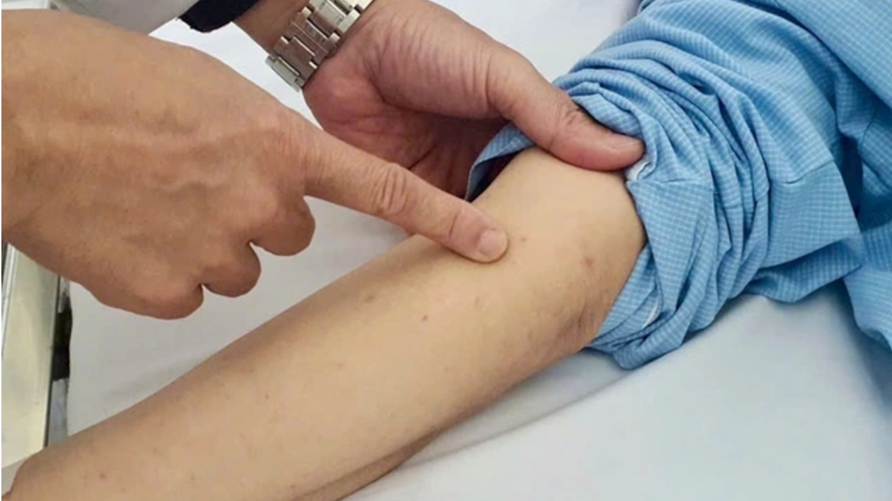 Bệnh viêm não mô cầu nguy hiểm như thế nào?